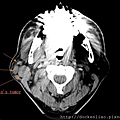 parotid warthin's tumor CT axi1.jpg