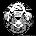 PAROTID TUMOR LEFT CT AXI 1.jpg