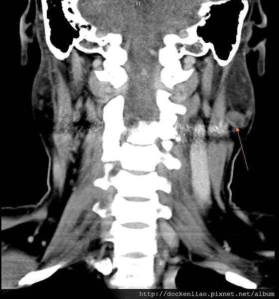 PAROTID TUMOR LEFT CT COR 1.jpg