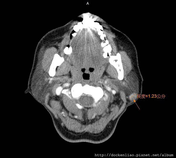 PAROTID Warthin's TUMOR LEFT CT axi.jpg