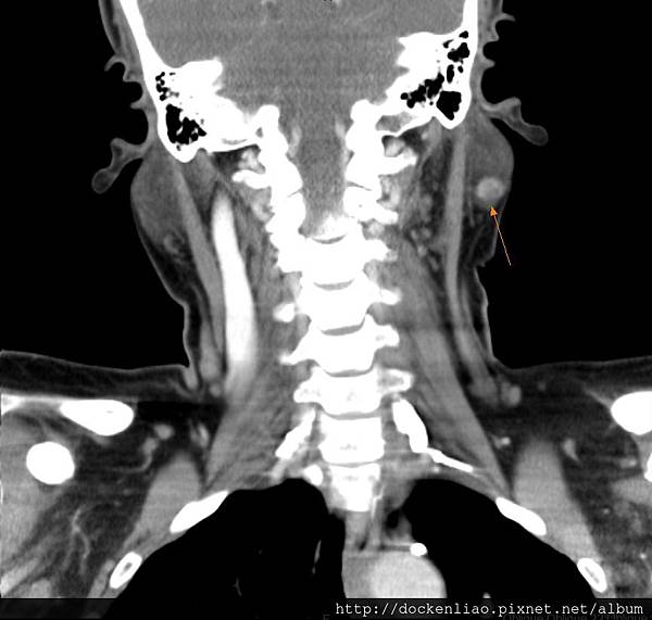 PAROTID Warthin's TUMOR LEFT CT COR.jpg