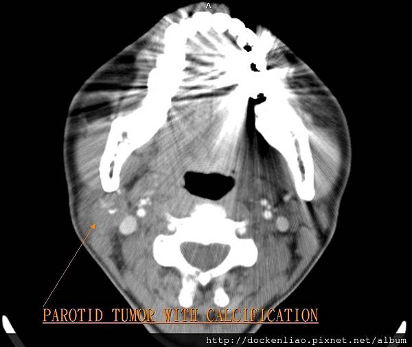 CT PAROTID TUMOR CALCIFIED AXI1.jpg