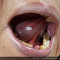 舌頭白斑 tongue leukoplakia 2016-03-11 10.57.54