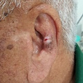 dilated pore of Winer, left auricle 2016-04