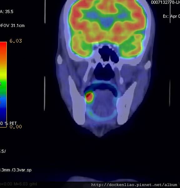 舌癌 正子電腦斷層 tongue cancer PET CT cor