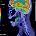 舌癌 正子電腦斷層 tongue cancer PET CT sag