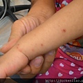 hand-food-mouth disease, Enterovirus , Herpangina  2016-09