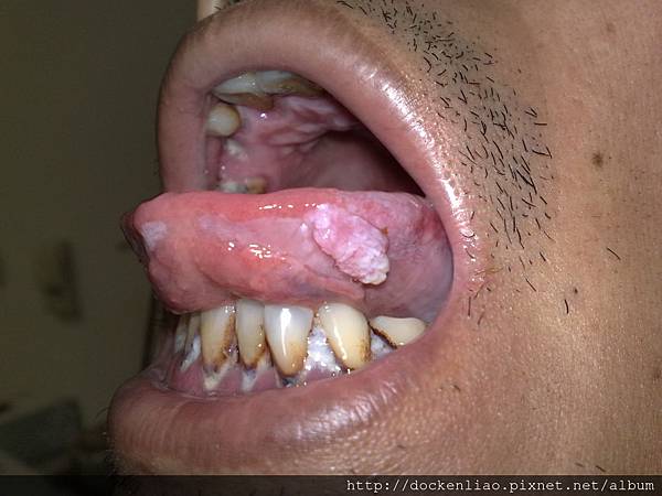 舌頭 乳突瘤 papilloma, tongue 劉耿僚