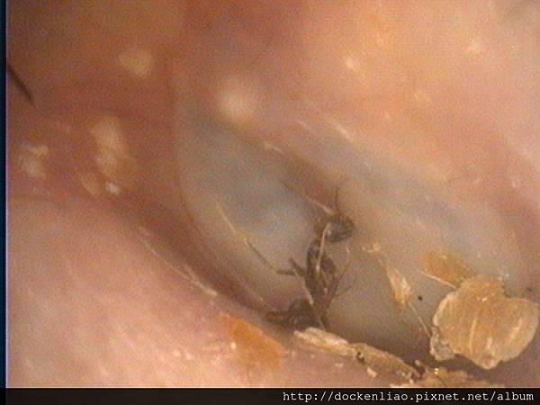 跑進耳朵的螞蟻 2016-10 ear ant foreign body 2