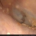 跑進耳朵的螞蟻 2016-10 ear ant foreign body 1
