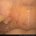 腸病毒 咽峽炎 口腔潰瘍 2016-06-27 048 herpangina soft palate ulcers