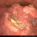 喉癌 口咽癌 epiglottis ca vallecular ca