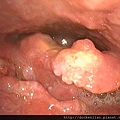 喉癌 口咽癌  epiglottis vallecula ca laryngeal oropharyngeal