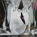 甲狀腺腫電腦斷層 氣管壓迫  huge thyroid tumor CT