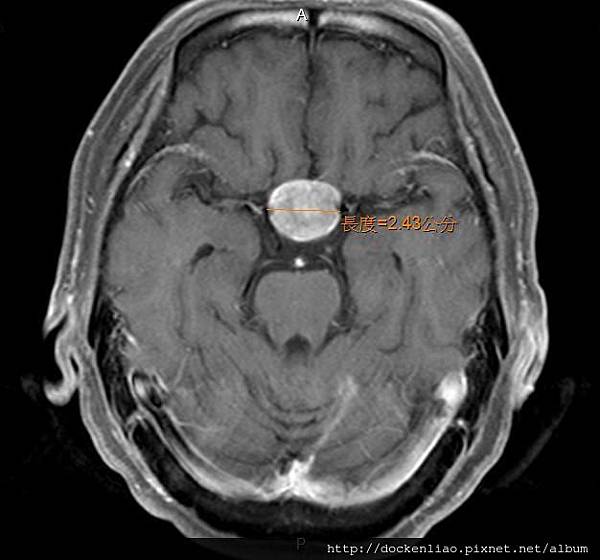pituitary adenoma MRI axi5.jpg
