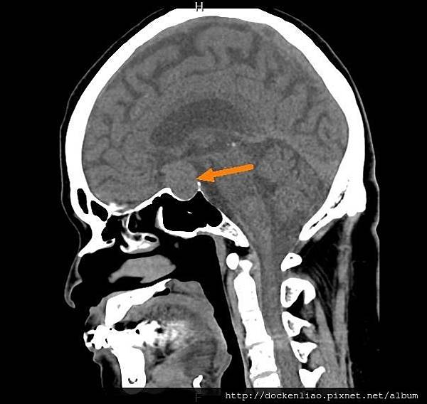 pituitary adenoma CTsag2.jpg