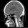 pituitary adenoma CTsag2.jpg