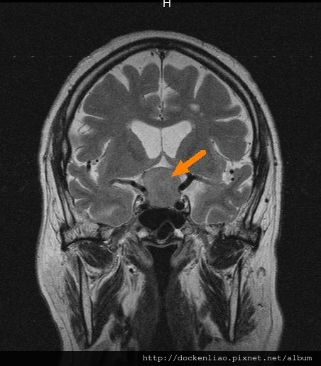 pituitary adenoma MRI cor1.jpg