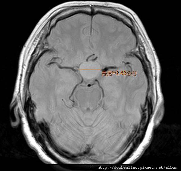 pituitary adenoma MRI axi1.jpg