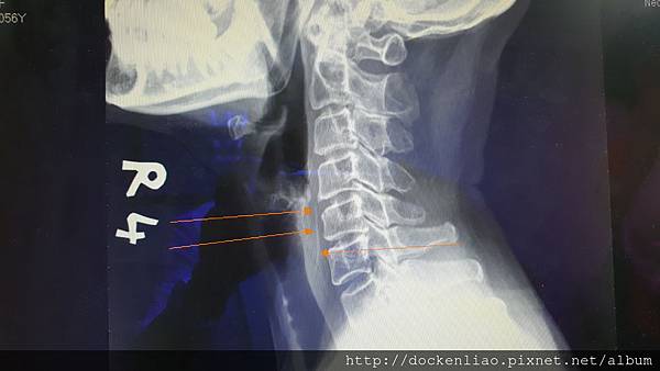 食道魚刺 X 光攝影檢查 fish bone in esophagus X-ray 2016-07-27