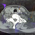 甲狀腺腫瘤出現鈣化，可能惡性機率大增 thyroid tumor & lipoma