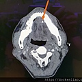 下頷腺管道Ｗharton's duct of submandibular gland內的結石  sialolith 劉耿僚