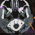 極度罕見的小兒瀰散性腮腺結石 very rare pediatric bilateral diffuse parotid gland sialolith CT scan