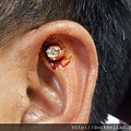 耳廓黑頭粉刺 皮脂腺囊腫 ear pinna auricle pimple blackhead sebaceous cyst