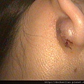 耳垂囊腫 皮脂腺囊腫 sebaceous cyst earlobe