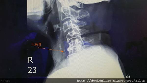 食道魚刺 X光檢查 fish bone x-ray