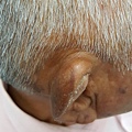 耳廓外傷性血腫 假性囊腫 auricle pseudocyst 3
