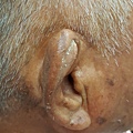 耳廓外傷性血腫 假性囊腫 auricle pseudocyst