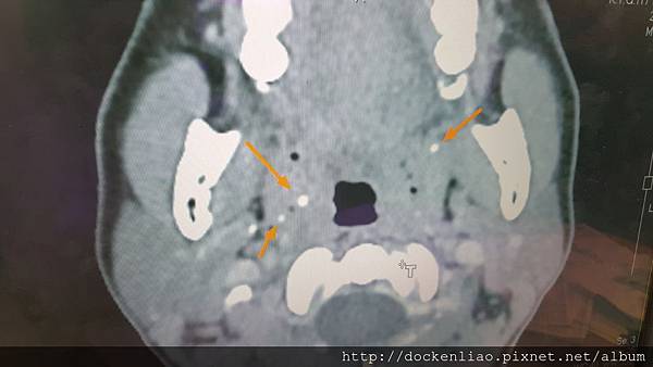 扁桃腺結石 劉耿僚醫師 bilateral tonsilith multiple CT (1)