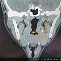 扁桃腺結石 劉耿僚醫師 tonsilith multiple CT (1)