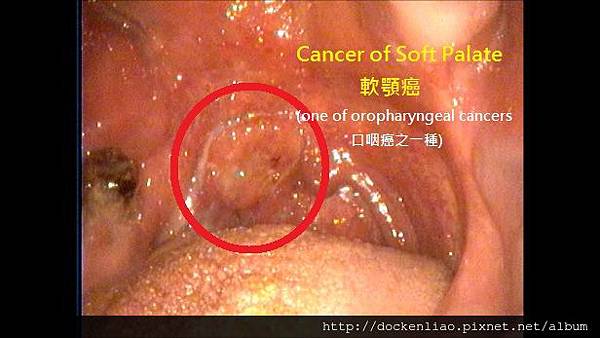 上顎軟顎癌 口咽癌之一 劉耿僚醫師 soft palate cancer