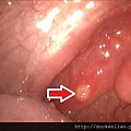 腸病毒 咽唊炎 herpangina pilar ulcer enterovirus 劉耿僚醫師