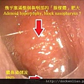 adenoid gland hypertrophy adenoid face Dr. Ken-Liao Liu 腺樣體肥大 劉耿僚醫師