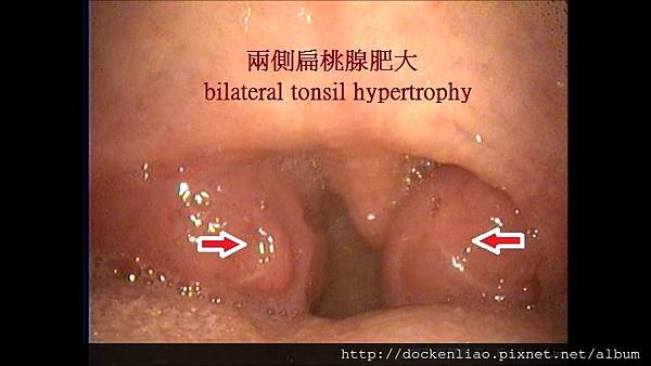 bilateral tonsil hypertrophy 扁桃腺肥大 劉耿僚醫師