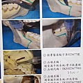 口腔癌手術利器 超音波骨刀 不傷軟組織20170907_213332 劉耿僚