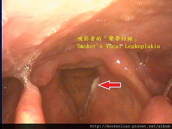 smoker's vocal leukoplakia vocal tumor 聲帶白斑 劉耿僚醫師 Dr. Ken Liao Liu