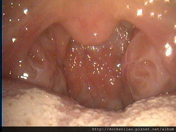 扁桃腺肥大 bilateral tonsil hypertrophy (2)
