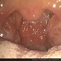 扁桃腺肥大 bilateral tonsil hypertrophy (2)