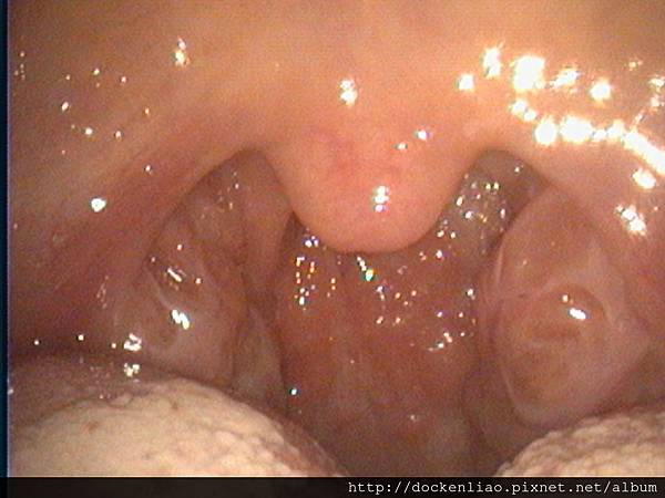 扁桃腺肥大 bilateral tonsil hypertrophy (1)
