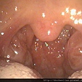 扁桃腺肥大 bilateral tonsil hypertrophy (1)