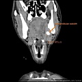submandibular sialolith submandibular stone CT cor2  唾液腺結石劉耿僚醫師