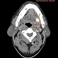 submandibular sialolith CT cor1 唾液腺結石 劉耿僚醫師