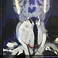 甲狀腺腫瘤電腦斷層 thyroid tumor CT scan 劉耿僚醫師