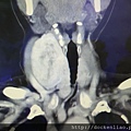 甲狀腺腫瘤電腦斷層 thyroid tumor CT scan 劉耿僚醫師