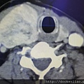 甲狀腺腫瘤電腦斷層 thyroid tumor CT scan 劉耿僚醫師