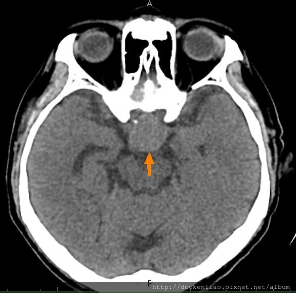 腦下垂體瘤 劉耿僚醫師 pituitary gland macroadenoma CT axi3